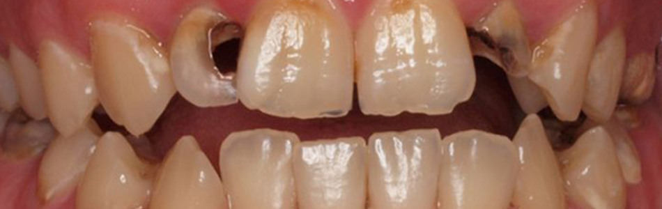 The effect of sugar on teeth
