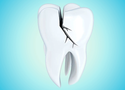 Dental Fractures: Why do teeth break?
