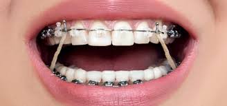 Braces and orthodontics