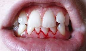 Bleeding gums