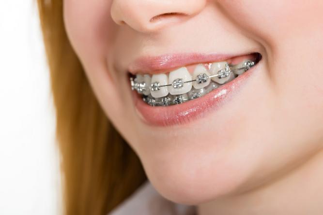 Brackets and orthodontics