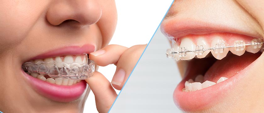 Traditional orthodontia or Invisalign invisible braces?