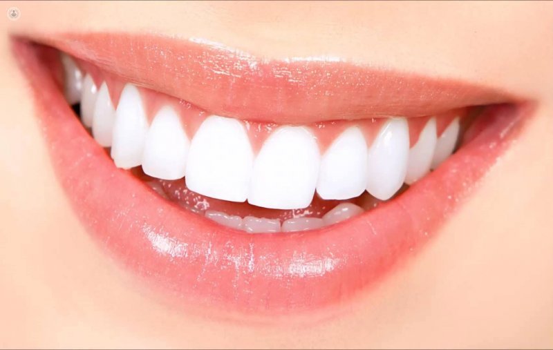 What are dental veneers?