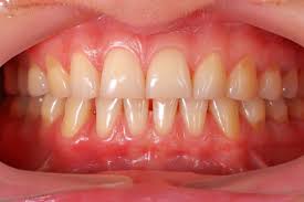 Gingivitis: Signs and Symptoms
