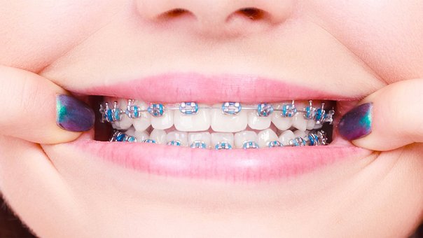 Braces and orthodontics