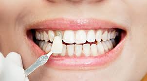 Dental Veneers: Advantages and Disadvantages