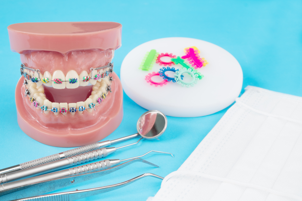 Types of Brackets: Which are the Indicated for Your Case?