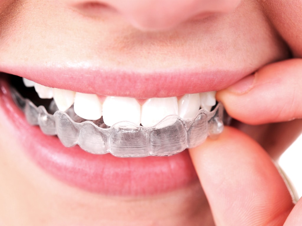 Smile confidently with Invisalign