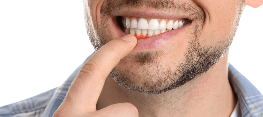 What you need to know about receding gums