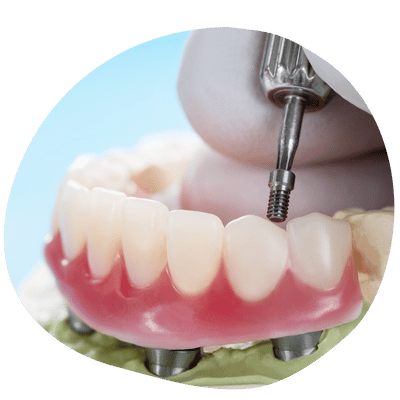 Tratamiento de implantes dentales All-on-4 en Top Dental Virginia y Maryland