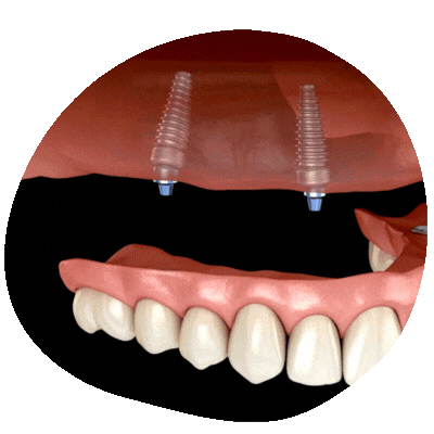 Implantes All on Four en Top Dental Virginia y Maryland
