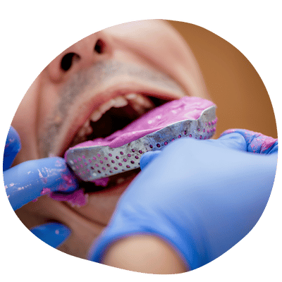 Prótesis dental personalizada en laboratorio Top Dental