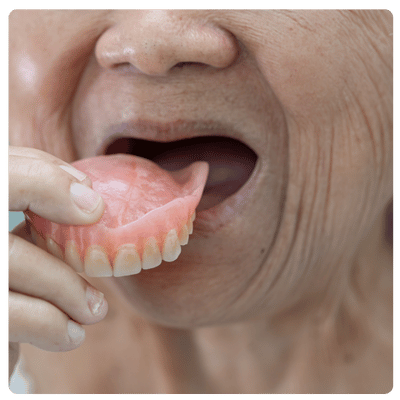 Dentaduras Parciales y Completas en Top Dental