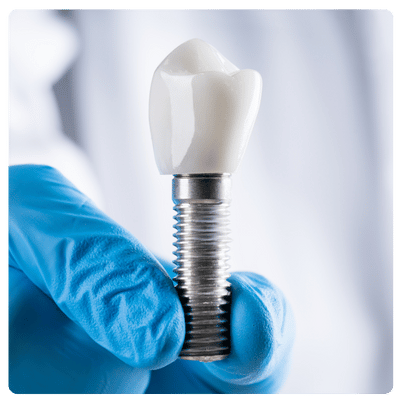 Implante Dental con Corona