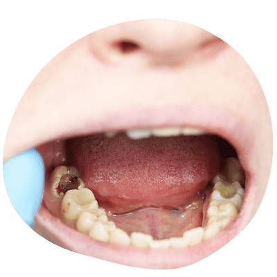Paciente recibiendo tratamiento endodóntico en Top Dental