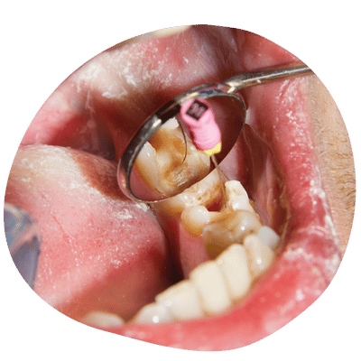 Endodoncia realizada por especialistas en Top Dental