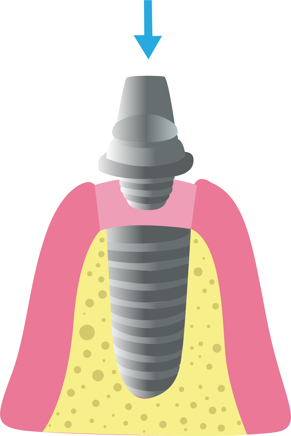 Partes de un implante dental - Top Dental