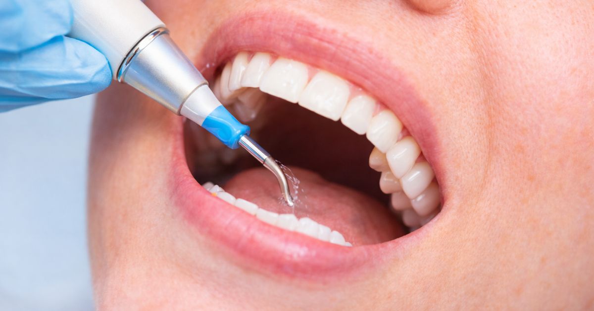 Promoción de limpieza profunda dental en Top Dental