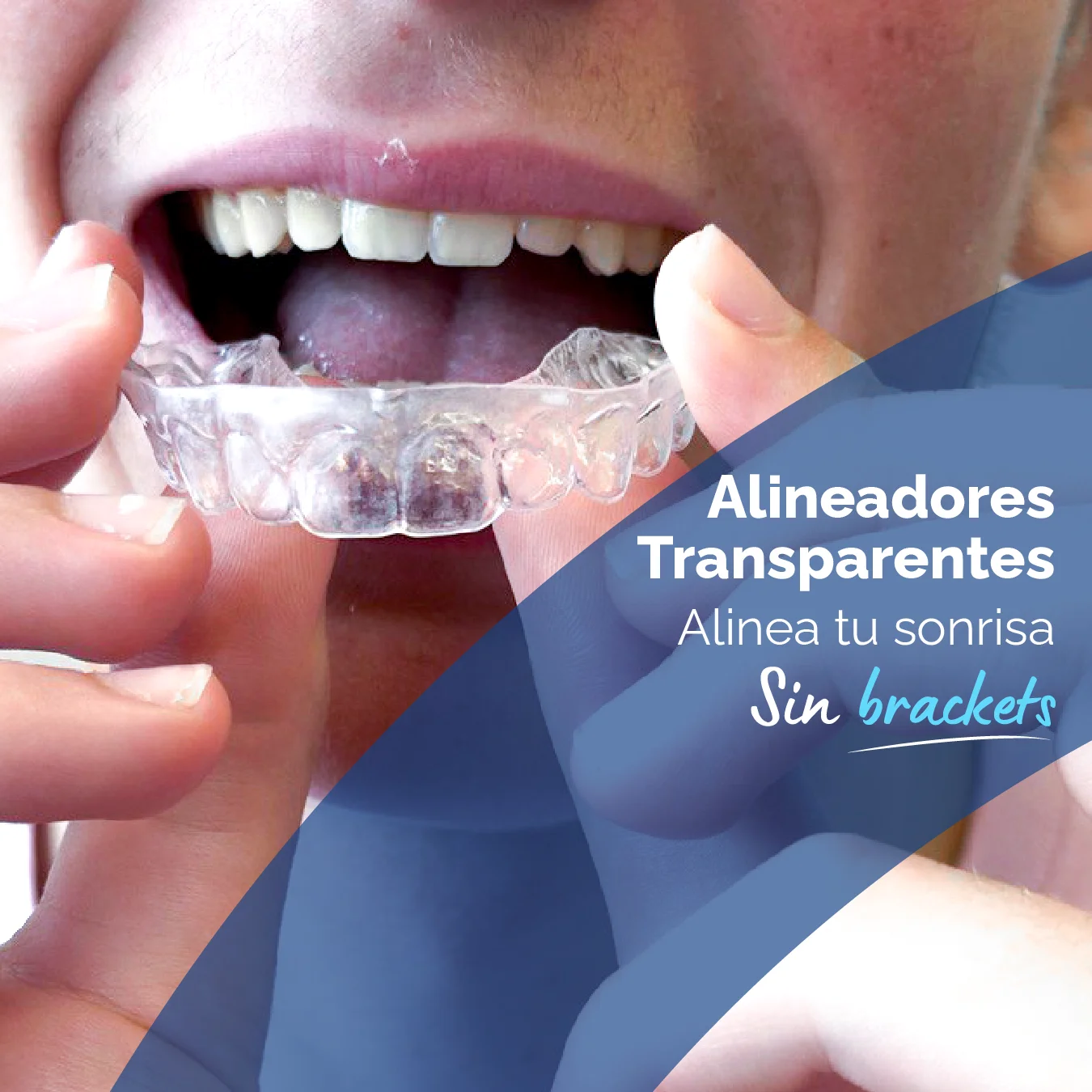 Alineadores transparentes (ortodoncia invisible) para alinear la sonrisa