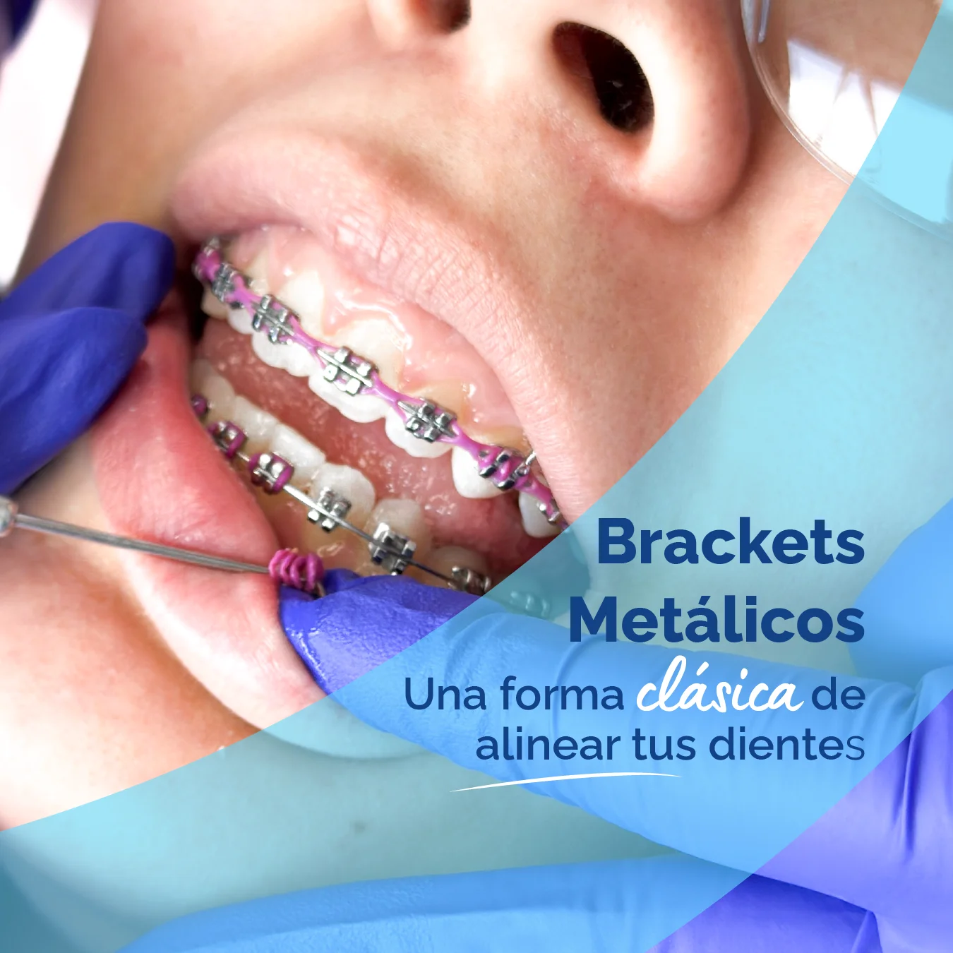 Brackets metálicos (frenillos) para corregir dientes torcidos y apiñamiento