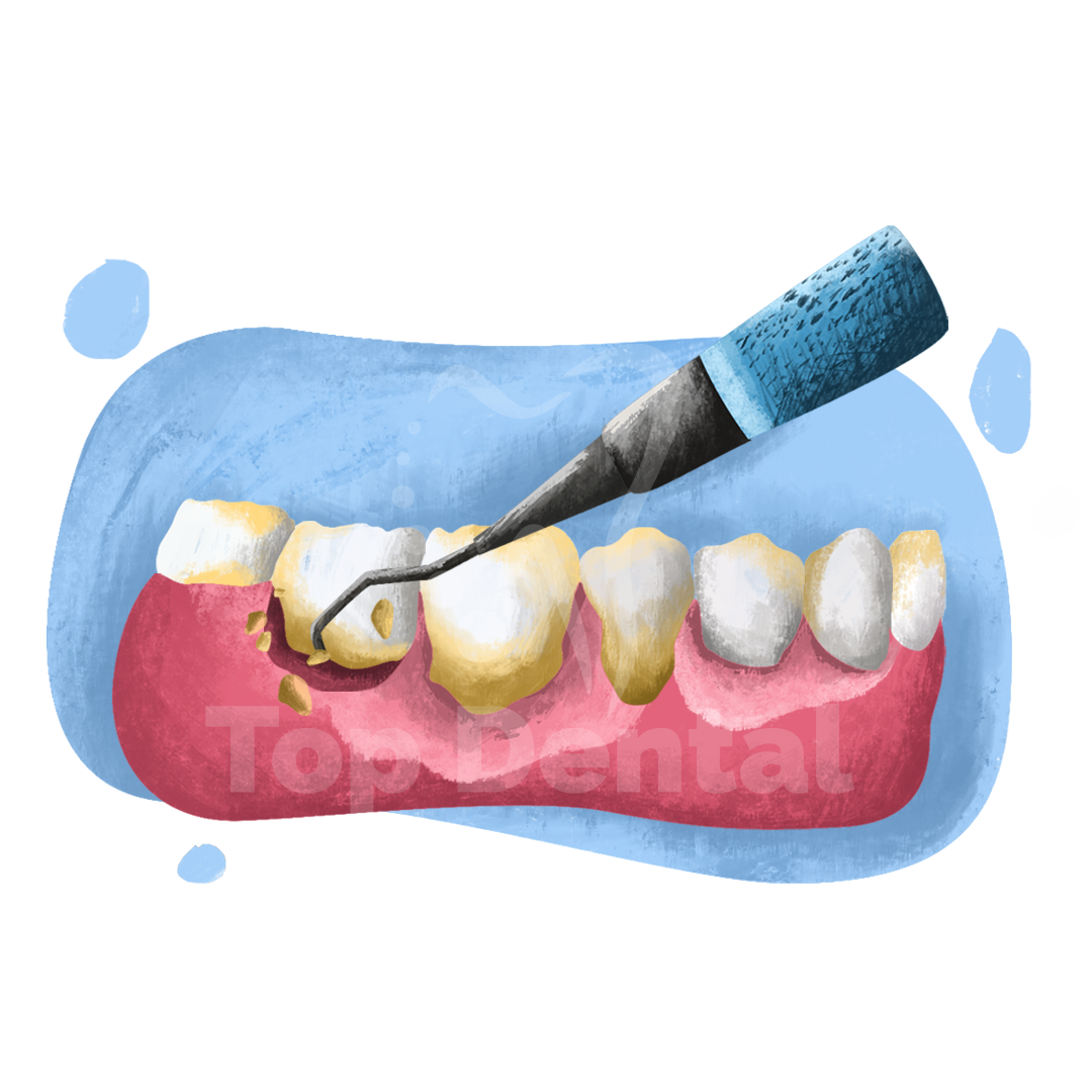 Limpiezas Dentales