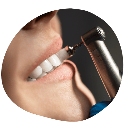 Dental Cleaning at Top Dental