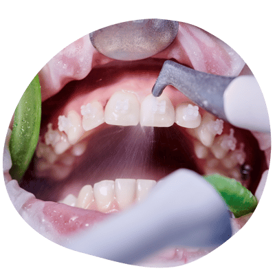 Professional Dental Cleaning at Top Dental