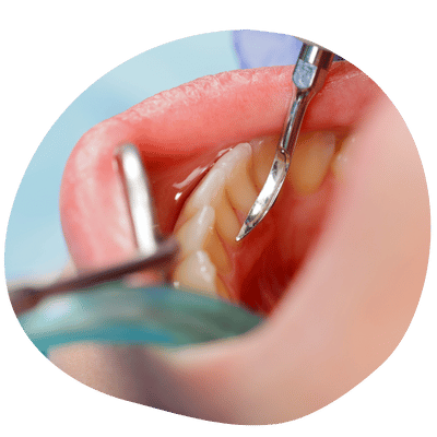 Dental Cleaning at Top Dental