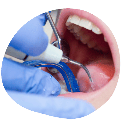 Professional Dental Cleaning at Top Dental