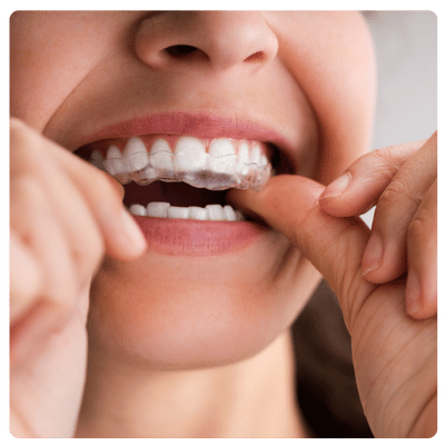 Clear Aligners