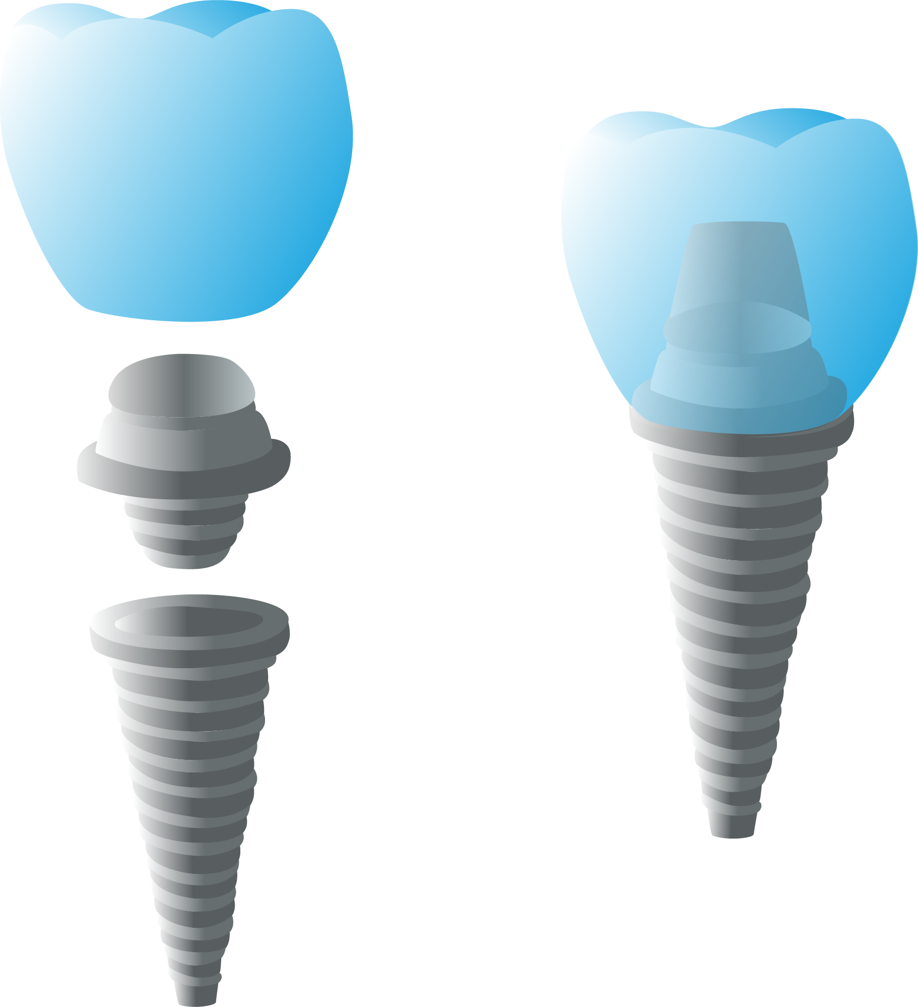 Parts of a Dental Implant - Top Dental