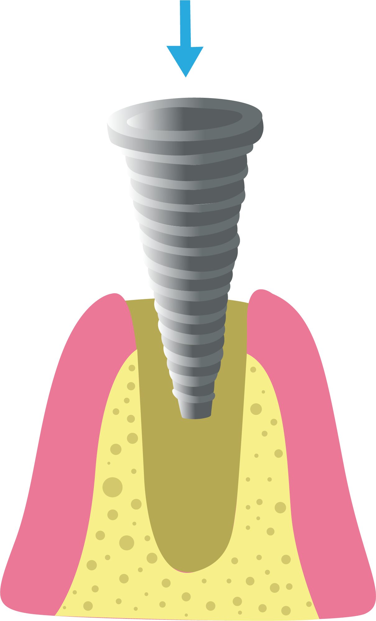 Partes de un implante dental - Top Dental