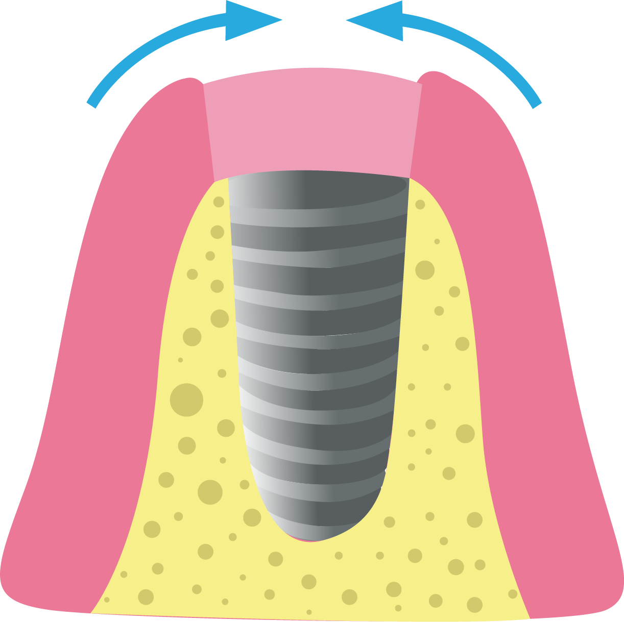 Partes de un implante dental - Top Dental