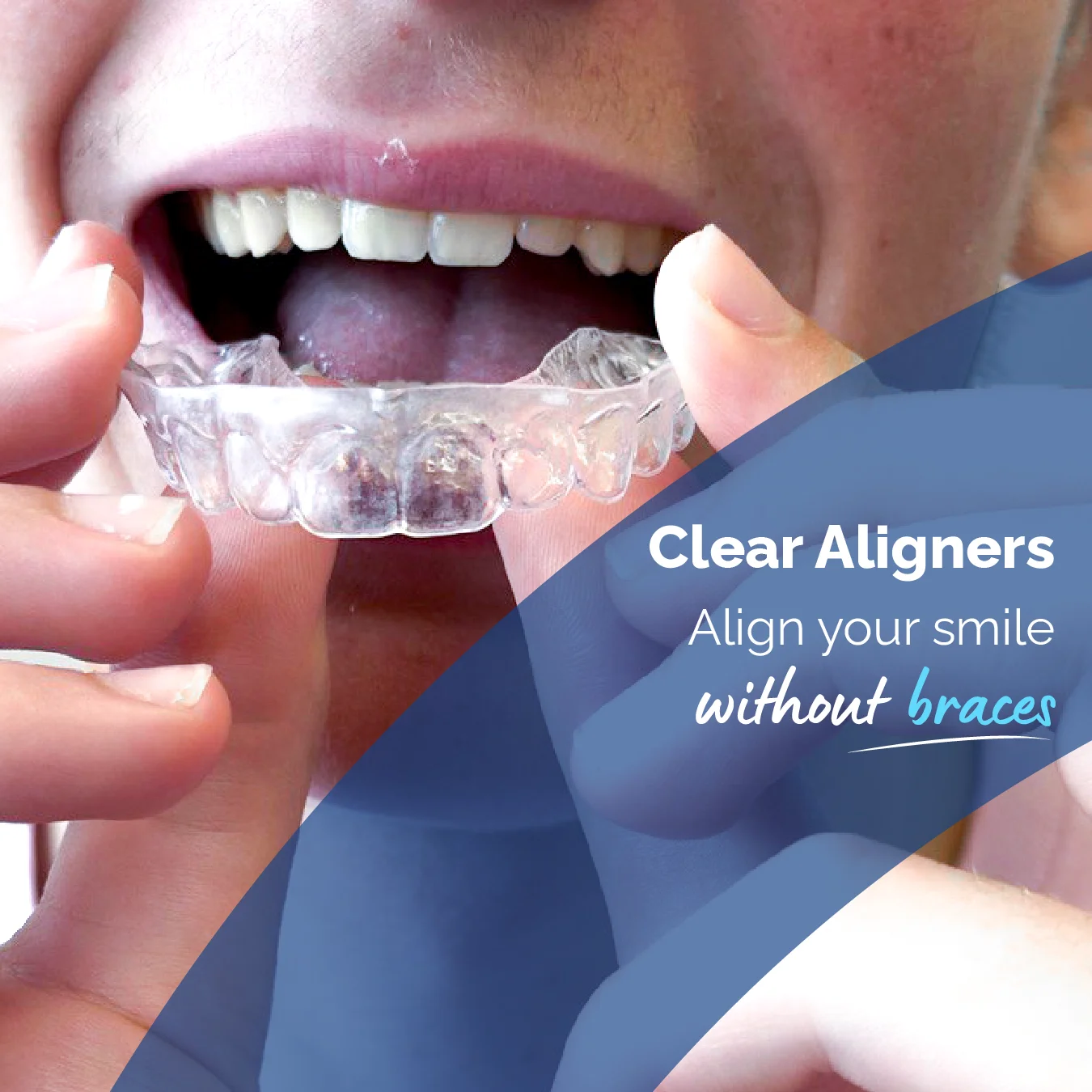Clear aligners as an orthodontic option to straighten teeth discreetly