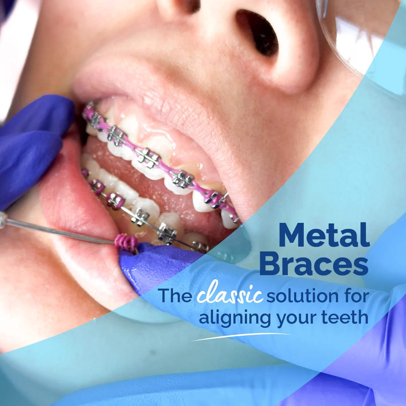 Metal braces to correct crowded teeth and improve bite alignment