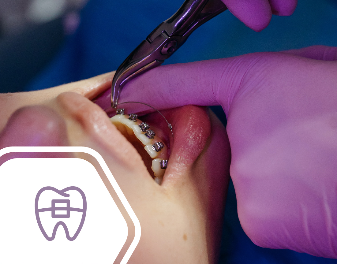 orthodontics, metal braces, brackets