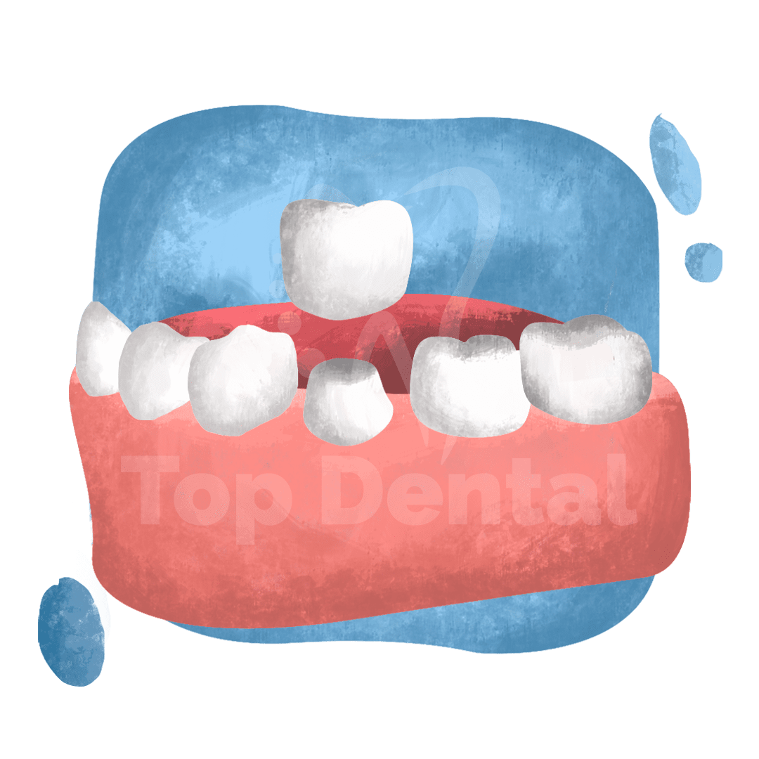 Crowns Top Dental