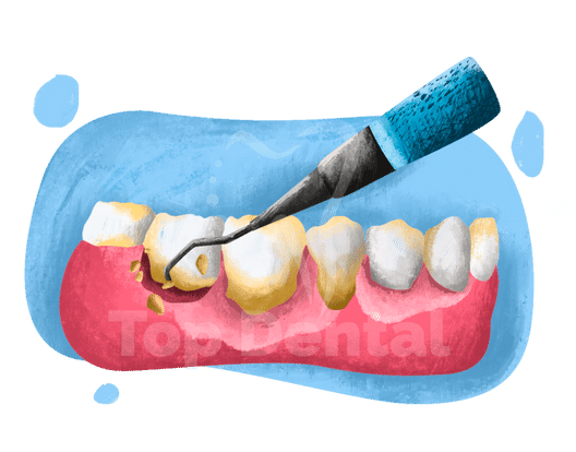 Deep Cleaning - Top Dental