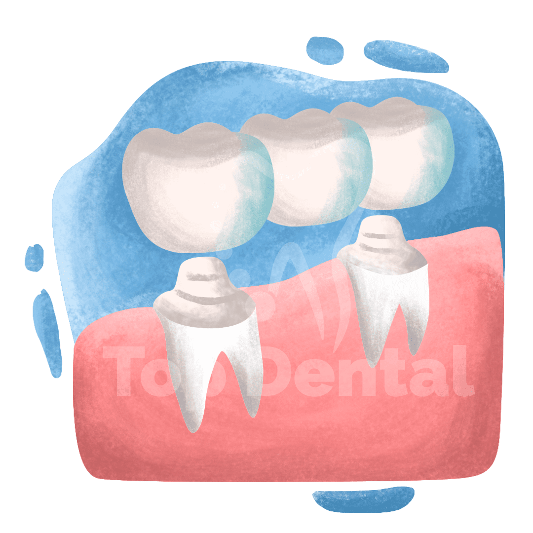 Bridges Top Dental