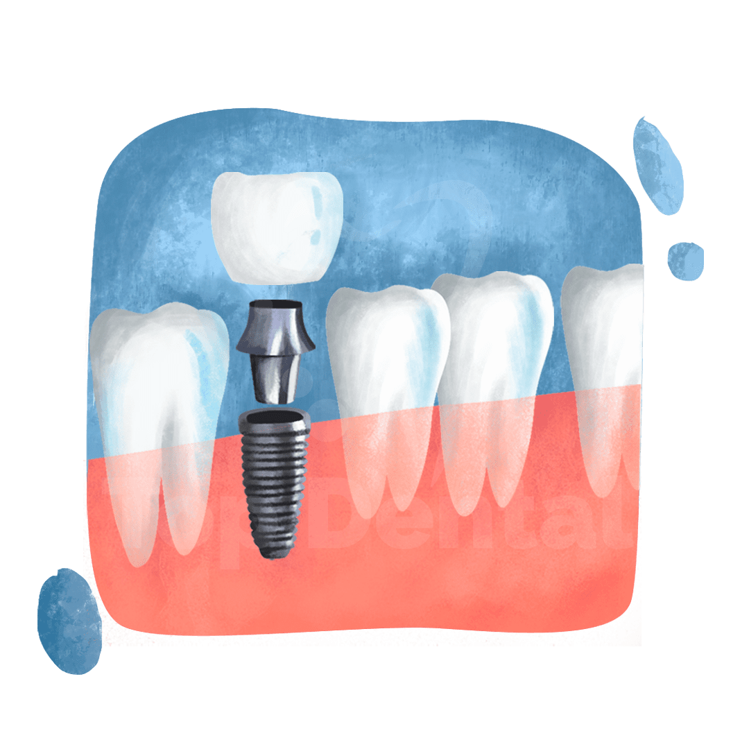 Dental Implant Top Dental