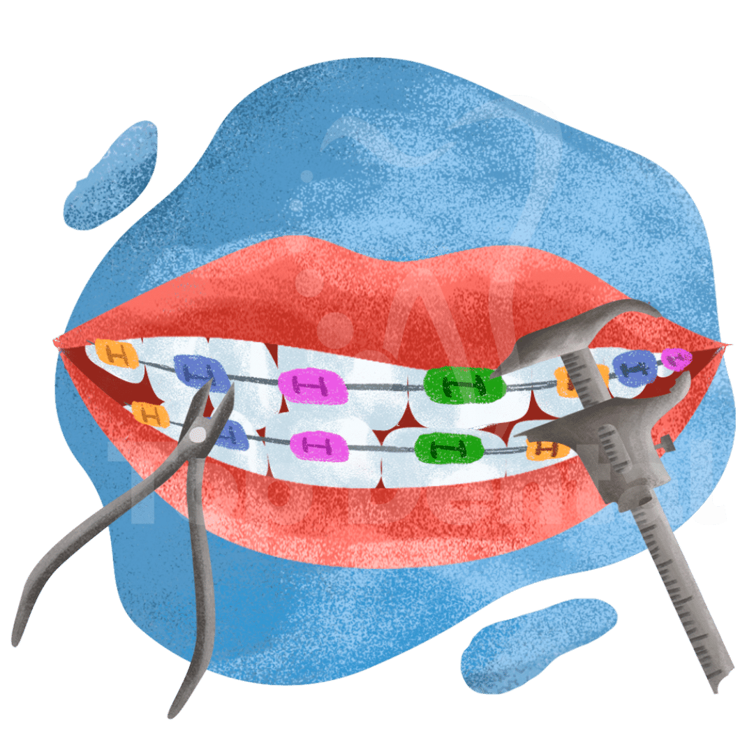 Metal Braces, orthodontist Top Dental