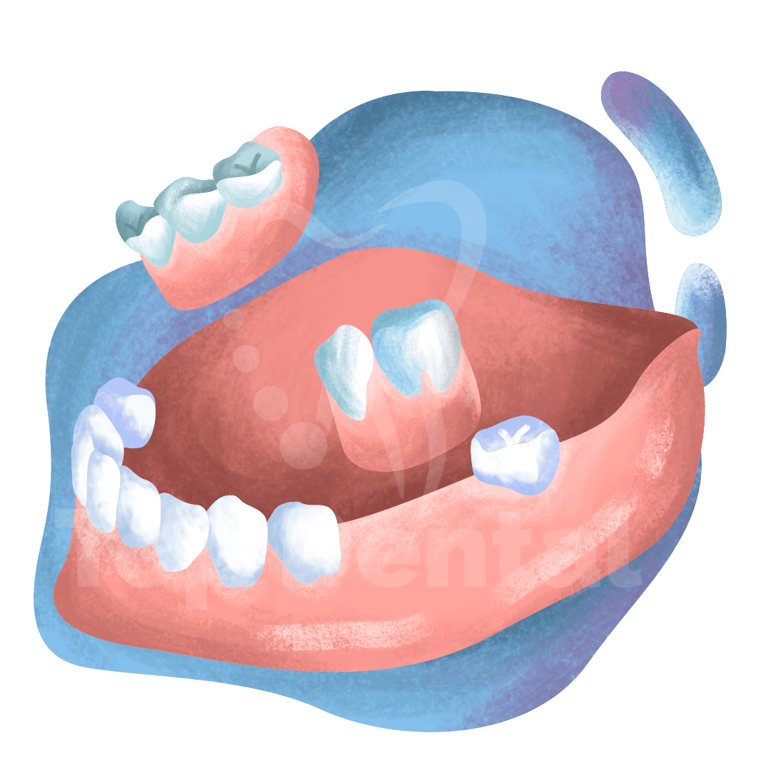 Removaible Partial Denture Top Dental