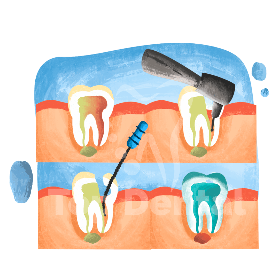 Root Canal Top Dental