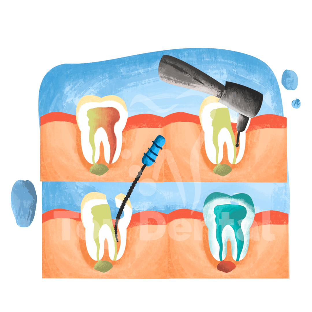 root-canal